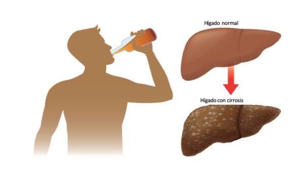 El alcohol afecta al hígado