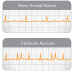 Tratamiento inicial de la fibrilación auricular en paciente hemodinámicamente inestable