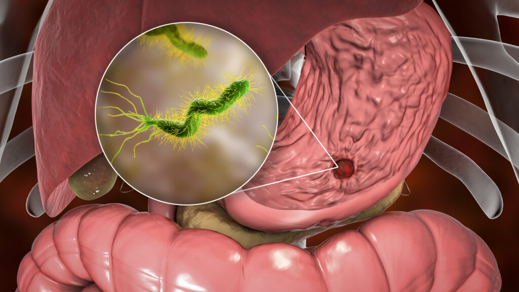 Riesgos por colonización de Helicobacter pylori