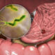 Riesgos por colonización de Helicobacter pylori