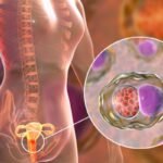 Prevención contra la infección por clamidia