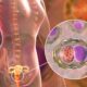 Prevención contra la infección por clamidia