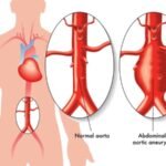 Detección de aneurisma de la aorta abdominal