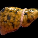 Respuesta inicial ante estímulos hepatotóxicos