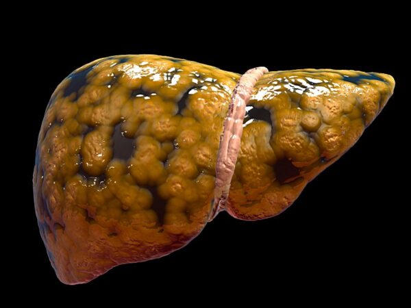 Respuesta inicial ante estímulos hepatotóxicos