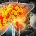 ¿Es reversible la esteatosis hepática por alcoholismo?