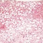 Características histológicas de la hepatitis alcohólica