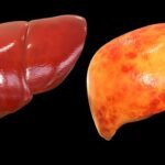 La hepatitis alcohólica es causa de cirrosis