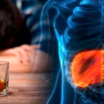 Detectar el consumo de alcohol en el hígado graso