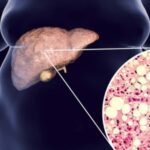 Influencia del alcohol en el metabolismo de los lípidos