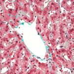 Lesión del hepatocito mediada por el acetaldehído