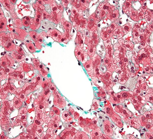 Lesión del hepatocito mediada por el acetaldehído