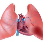 tromboembolia pulmonar