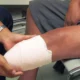 Amputación en pacientes con enfermedad arterial oclusiva pedia y tibial
