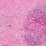 ¿Qué es la tiroiditis de Riedel?