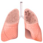 ¿Qué es el enfisema pulmonar?