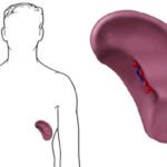 Hiperesplenismo en cirrosis alcohólica