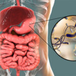 Helicobacter pylori es factor clave en la enfermedad ácido péptica