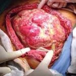 ¿Qué es el abdomen hostil?