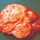 ¿Qué es un glucagonoma?