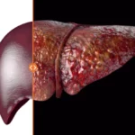 ¿La cirrosis es una enfermedad irreversible?