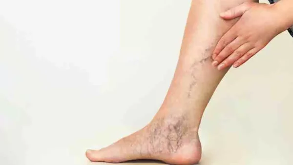 ¿Por qué los síntomas vasculares son tan variados?