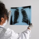 edema pulmonar