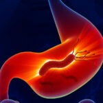Relación entre las úlceras gástricas y duodenales con H. pylori