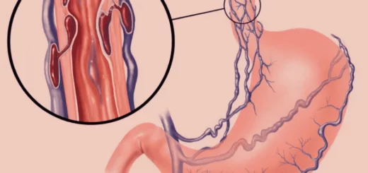 Factores de riesgo de hemorragia por várices esofágicas