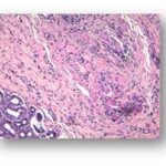 Histopatología de la inflamación idiopática de la órbita