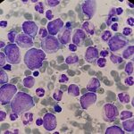 ¿Qué es la hiperleucocitosis?