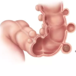 Tratamiento de la diverticulitis no complicada