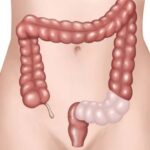 Indicación de cirugía en diverticulitis no complicada