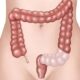 Indicación de cirugía en diverticulitis no complicada