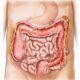 Manifestaciones de diverticulitis complicada