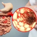 Manifestaciones extraintestinales de la enfermedad de Crohn