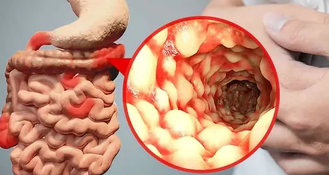 Manifestaciones extraintestinales de la enfermedad de Crohn