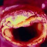 Principal causa de muerte en pacientes con diabetes