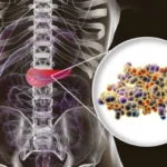 Consecuencia de la secreción insuficiente de insulina