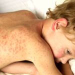 ¿Cómo es el exantema del sarampion?