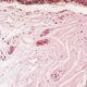 ¿A que se refiere el término amiloidosis?