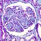 Agregados extracelulares de la amiloidosis