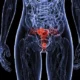 Causas de sangrado uterino anormal en premenopáusicas