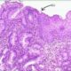 Unión escamocolumnar del cuello uterino