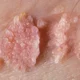 ¿Qué virus causan las verrugas genitales?