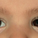 Movimientos extraoculares anormales