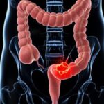 Opciones para detección de cáncer colorrectal