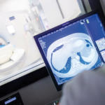 Detección de cáncer pulmonar en pacientes fumadores