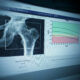 ¿A quíenes se recomienda la detección de osteoporosis?