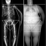 ¿Cuál es el factor predictivo mas preciso de fractura de cadera?